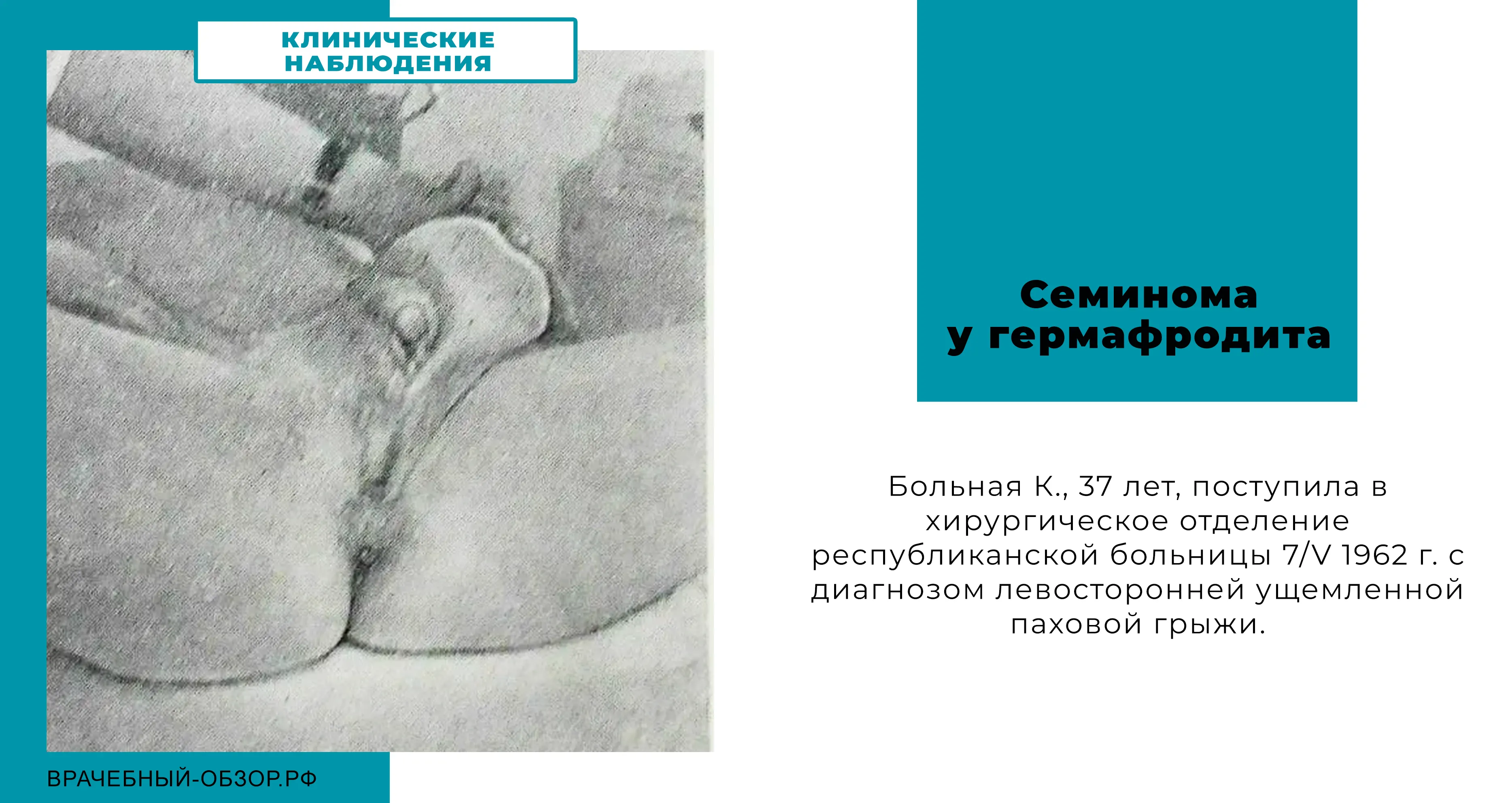 Семинома у гермафродита