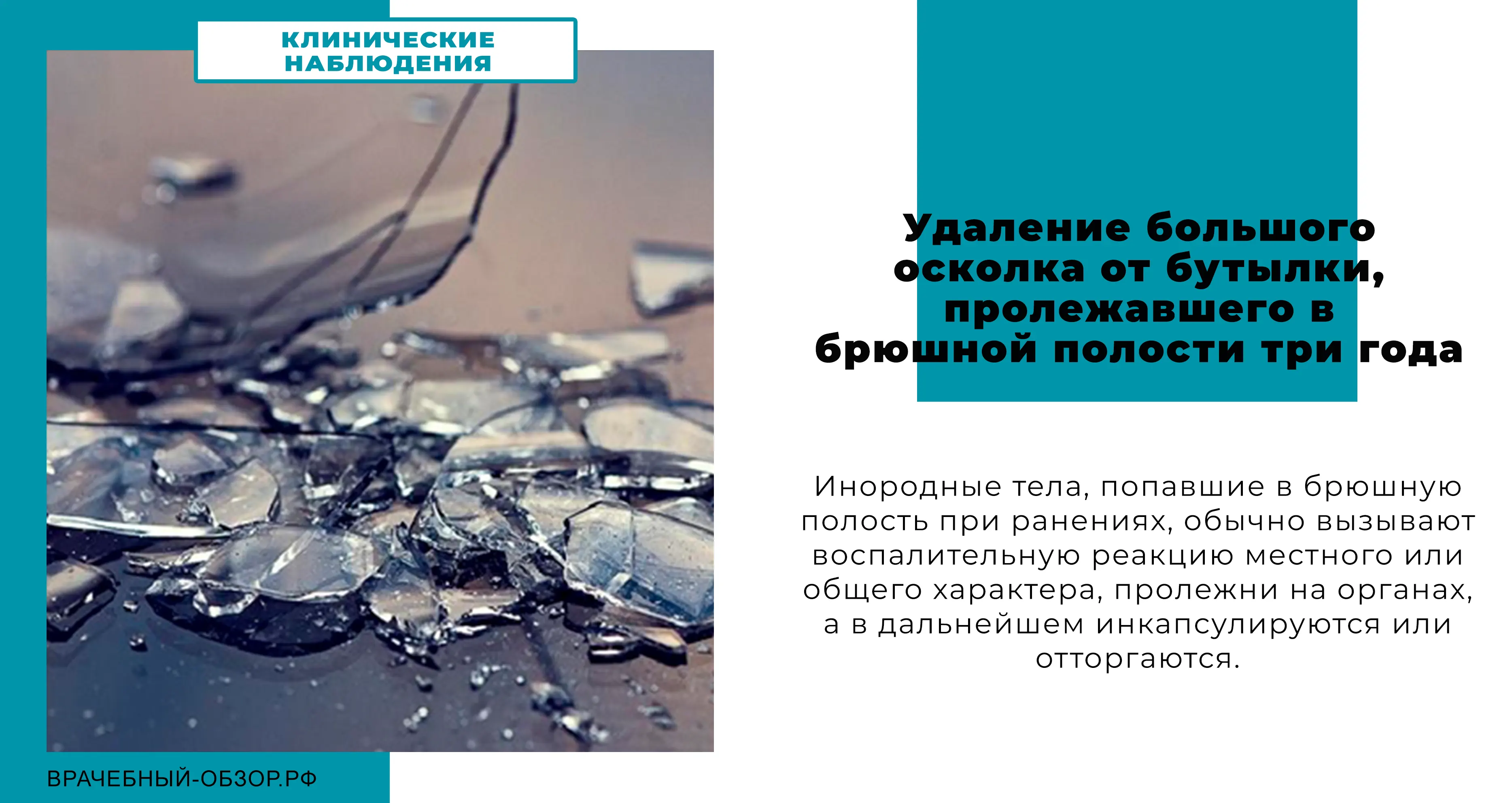 Удаление большого осколка от бутылки, пролежавшего в брюшной полости три года