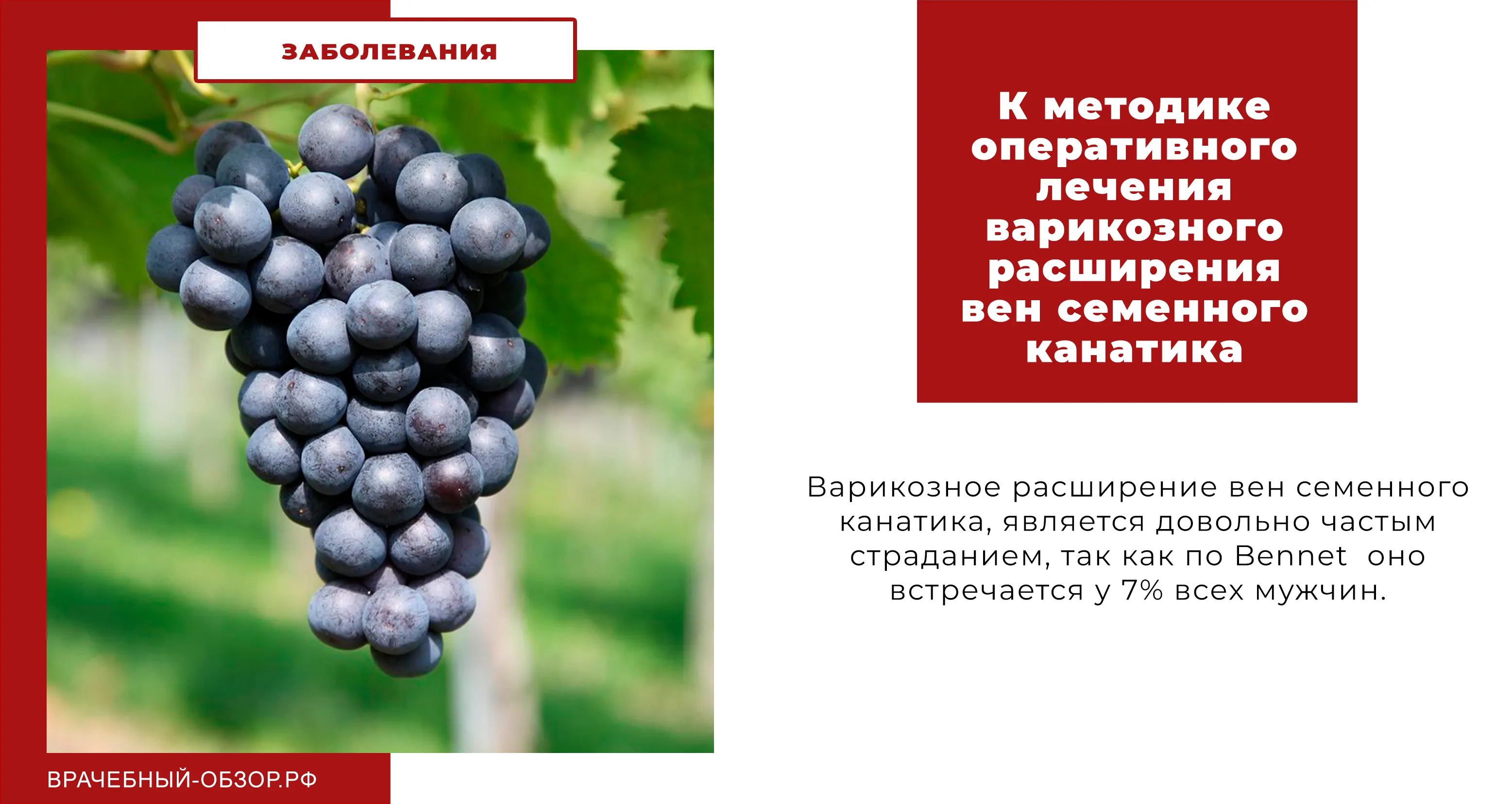 К методике оперативного лечения варикозного расширения вен семенного канатика