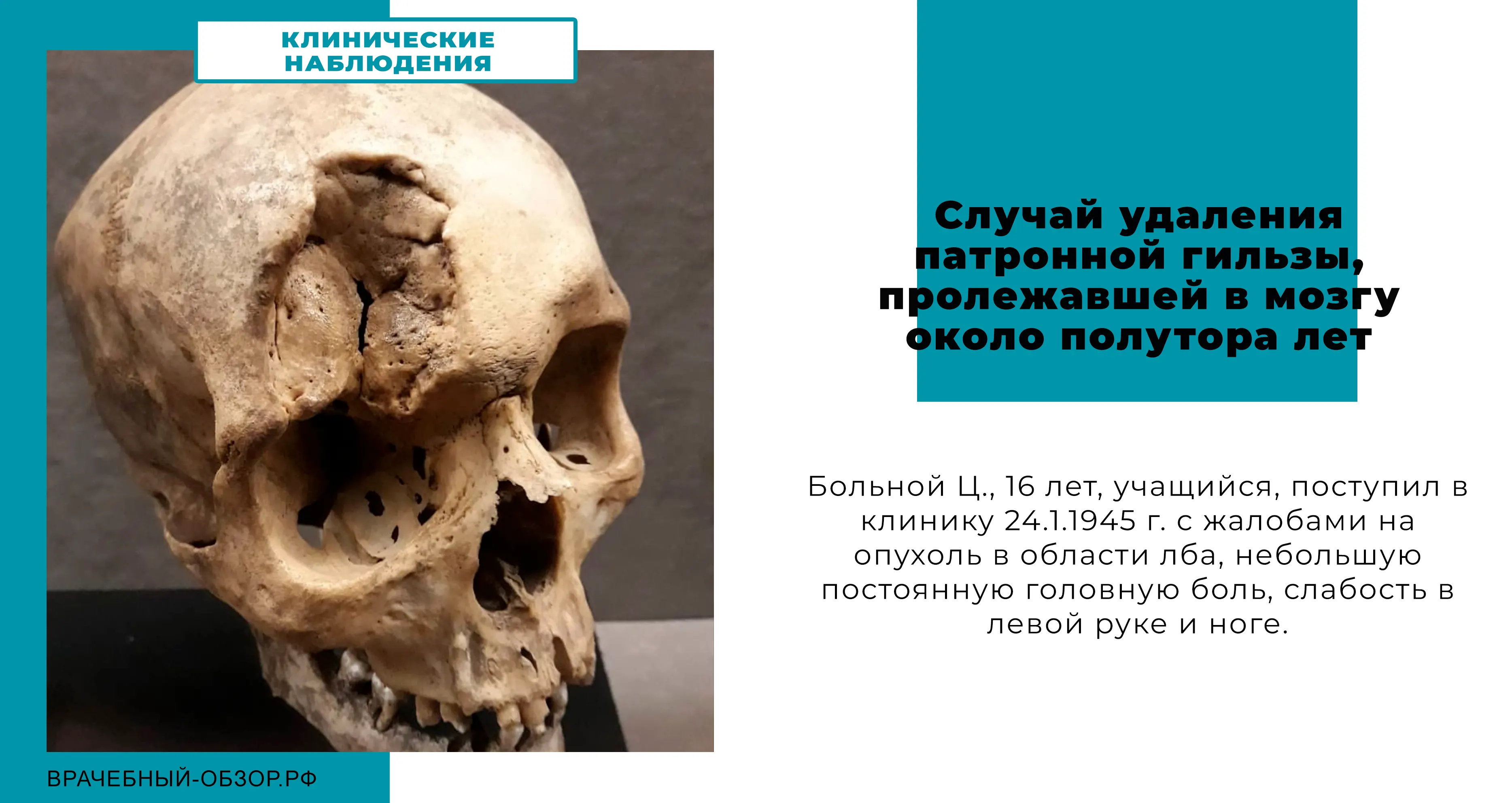 Случай удаления патронной гильзы, пролежавшей в мозгу около полутора лет