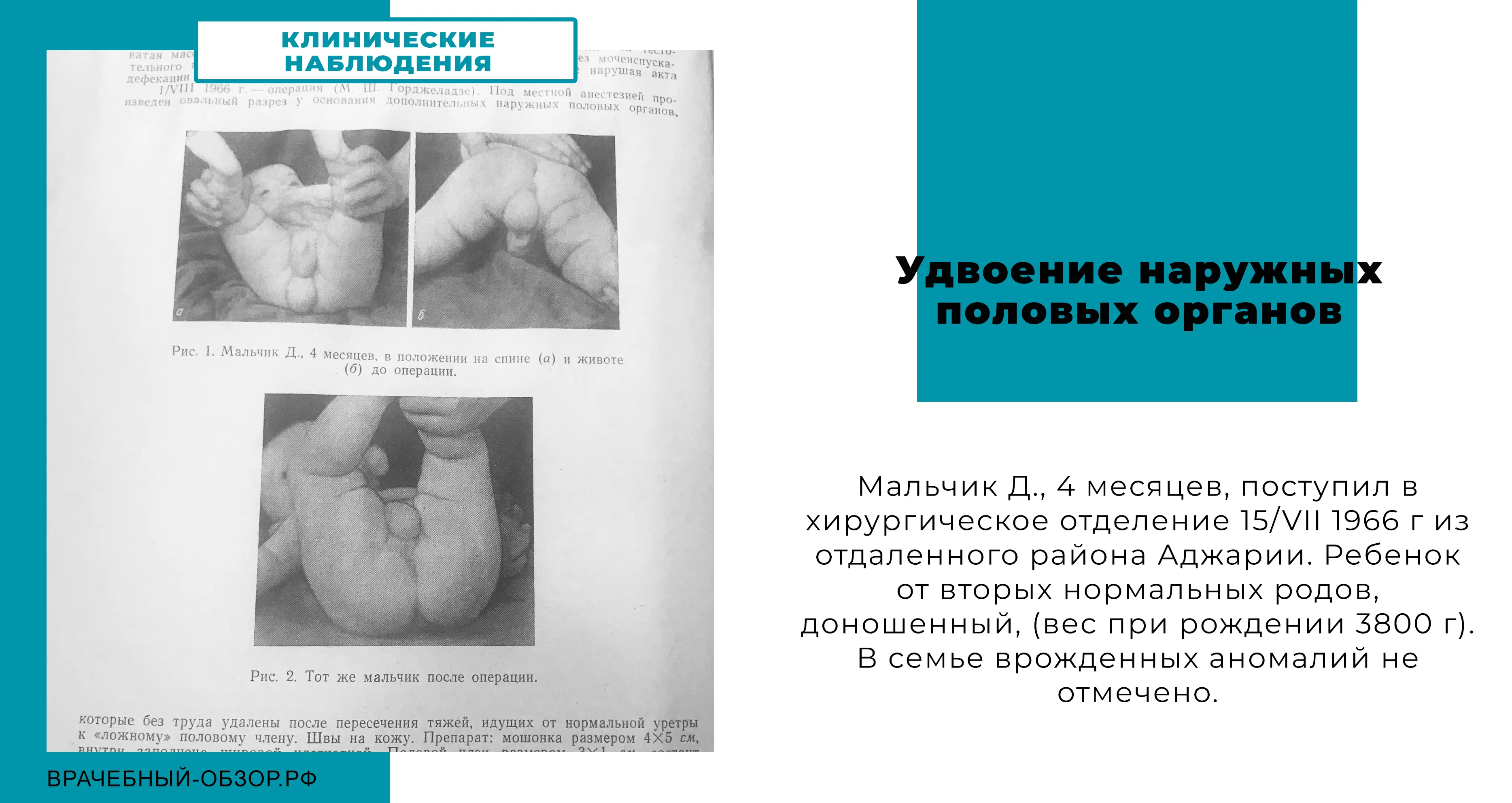 Удвоение наружных половых органов