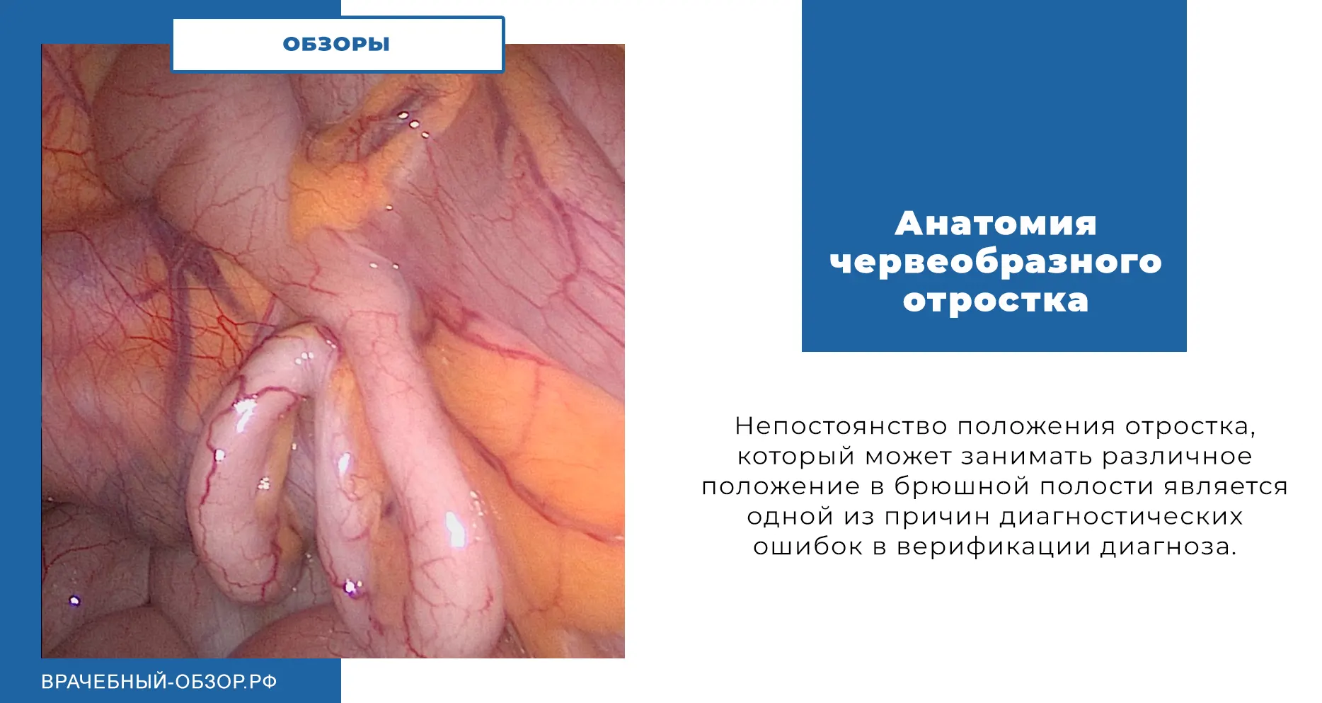 Анатомия червеобразного отростка