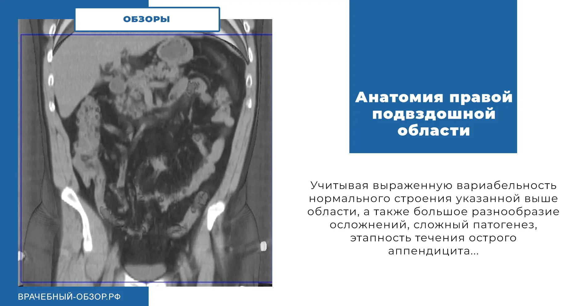 Анатомия правой подвздошной области