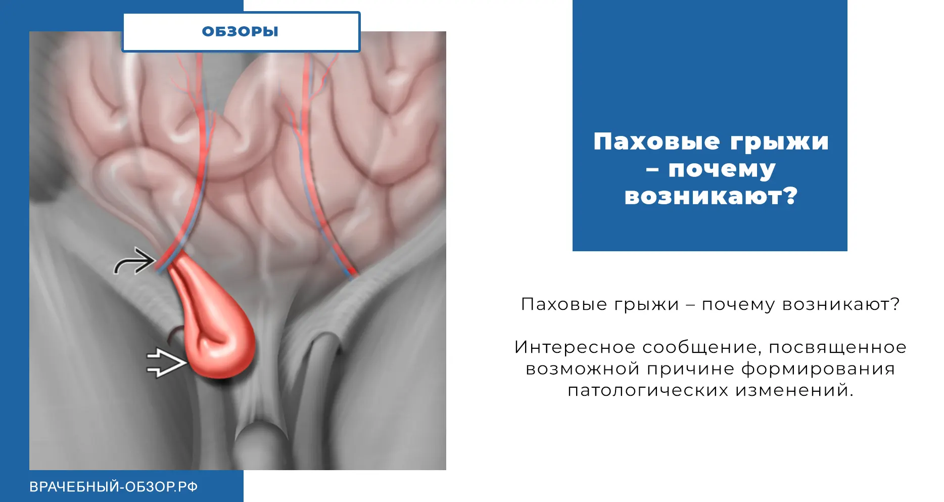 Паховые грыжи – почему возникают?