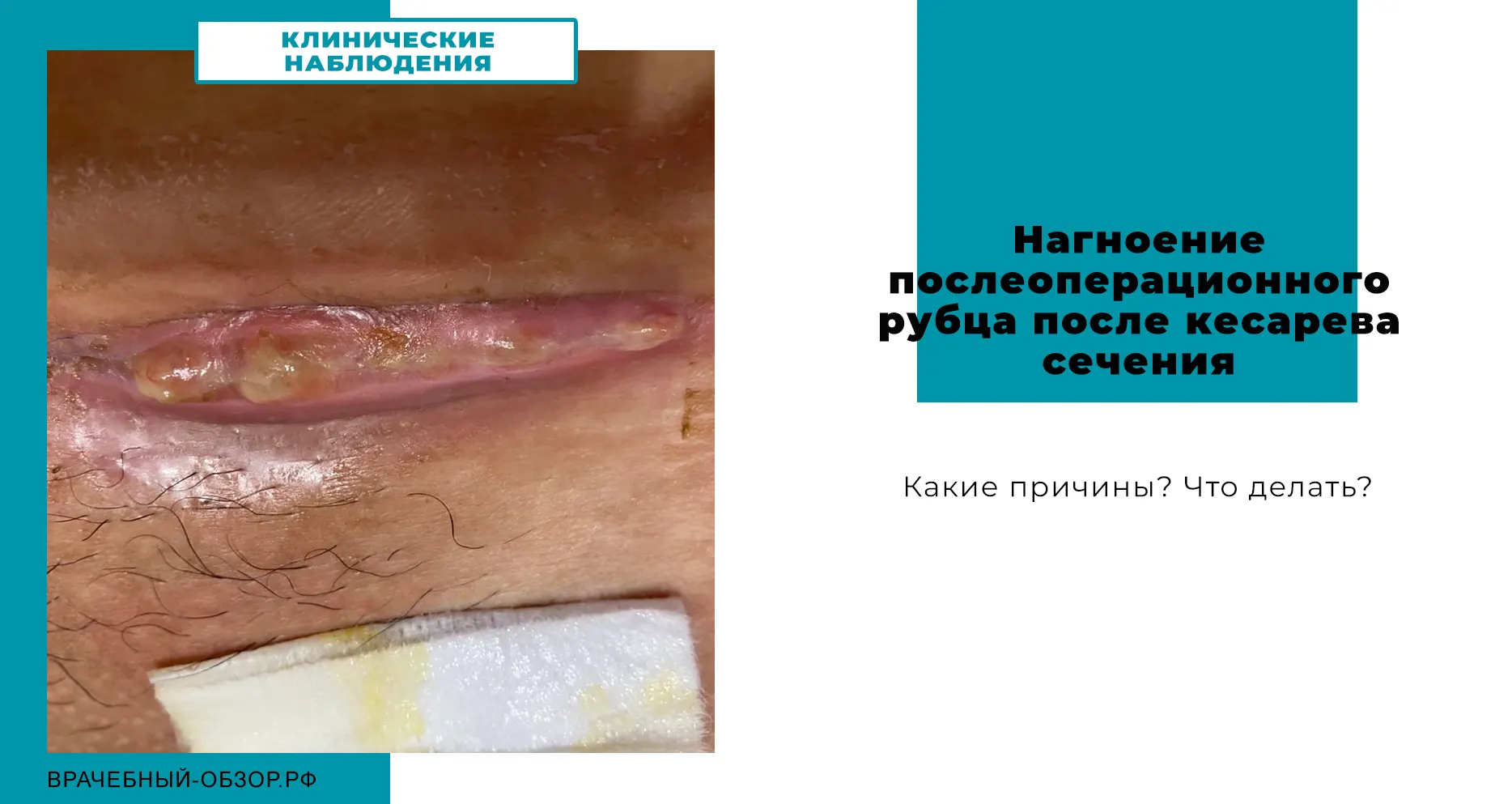 Нагноение послеоперационного рубца после кесарева сечения