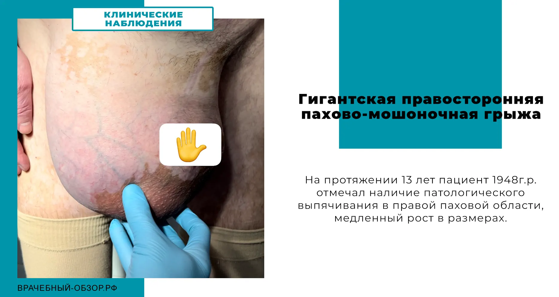 Гигантская правосторонняя пахово-мошоночная грыжа